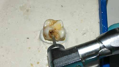 上颌第一磨牙开髓入口