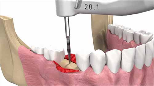 植牙术——插入种植体