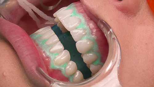 如何使用牙齿美白胶