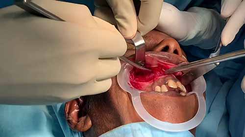 正颌外科手术